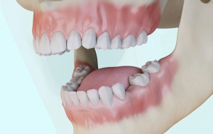 Le remplacement des dents absentes
