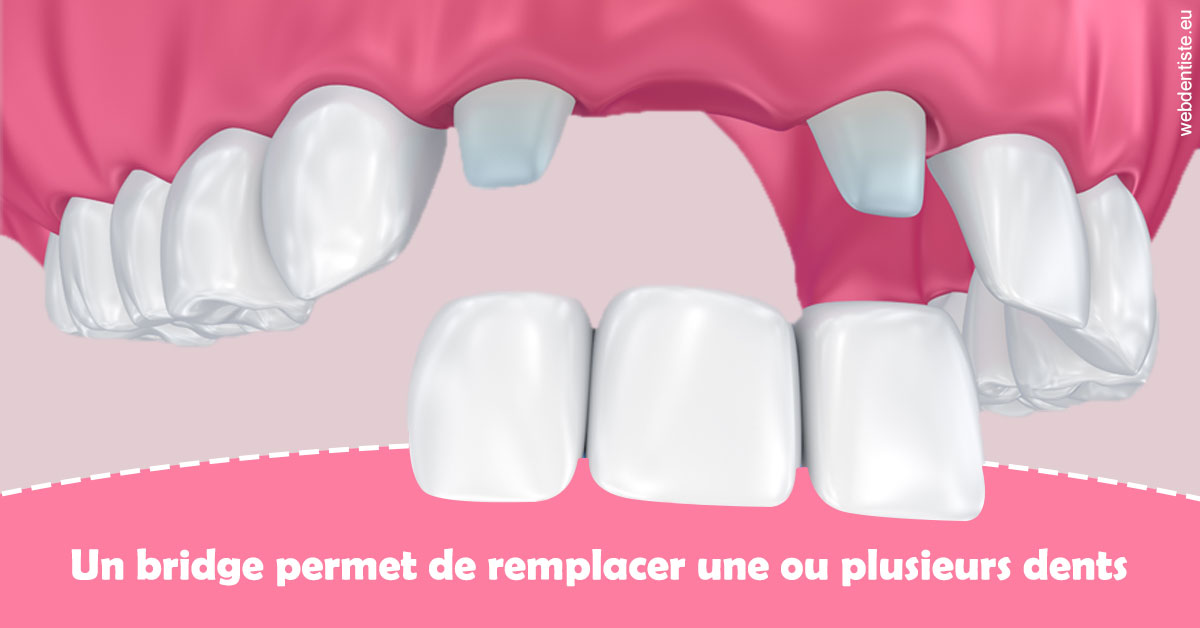 https://selarl-docteurs-korbendau.chirurgiens-dentistes.fr/Bridge remplacer dents 2