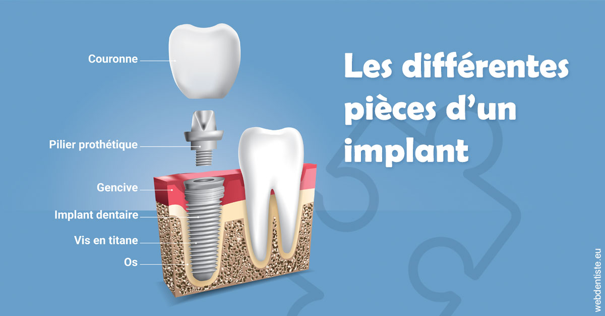 https://selarl-docteurs-korbendau.chirurgiens-dentistes.fr/Les différentes pièces d’un implant 1