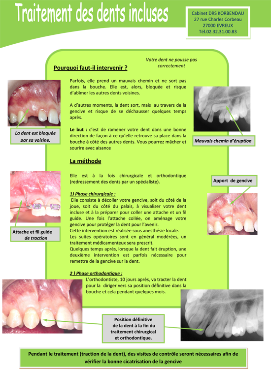 Traitement-des-dents-incluses (1)